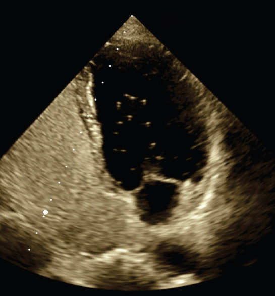 Huge Chiari Network in the Right Atrium Diagnosed as Thrombosis - Case Report and a Brief Review.