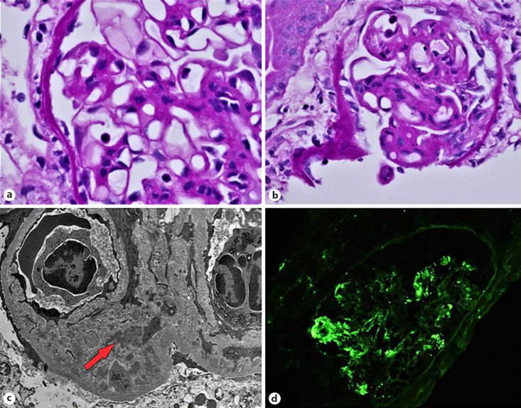 Repository Corticotropin in Treating de novo C3 Glomerulonephritis after Transplantation.