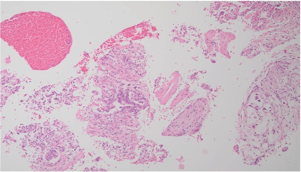 Ultrasound-guided Percutaneous Core-needle Biopsy of Focal Pancreatic Lesions - Practical Aspectss.