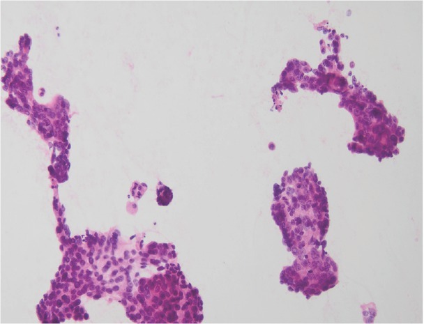 Ultrasound-guided Percutaneous Core-needle Biopsy of Focal Pancreatic Lesions - Practical Aspectss.