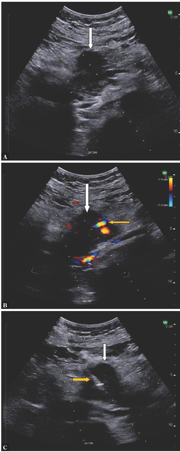 Ultrasound-guided Percutaneous Core-needle Biopsy of Focal Pancreatic Lesions - Practical Aspectss.