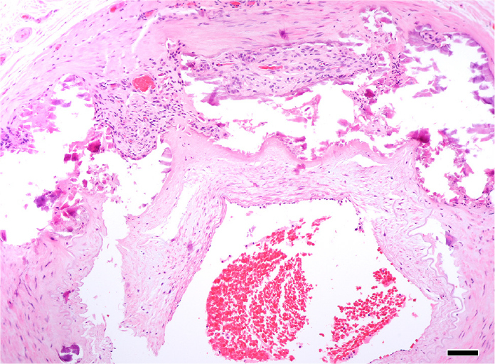 Mönckeberg sclerosis with giant cells as a masquerade of giant cell arteritis.