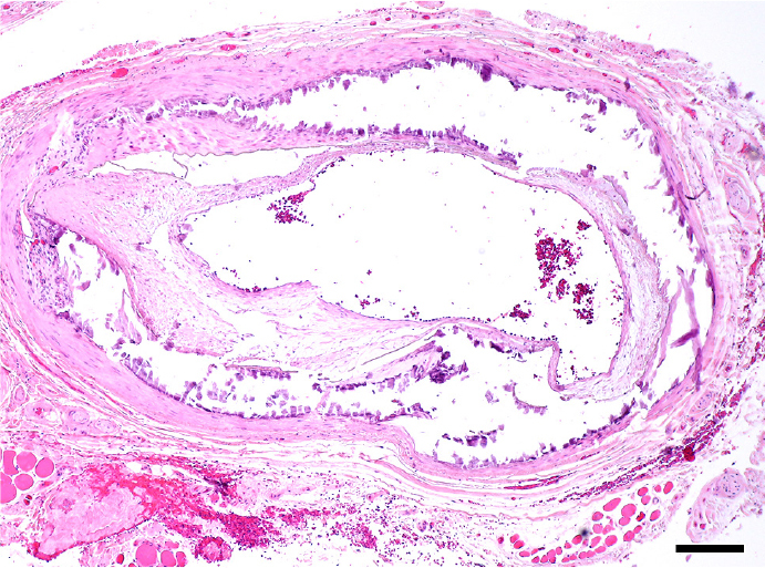 Mönckeberg sclerosis with giant cells as a masquerade of giant cell arteritis.