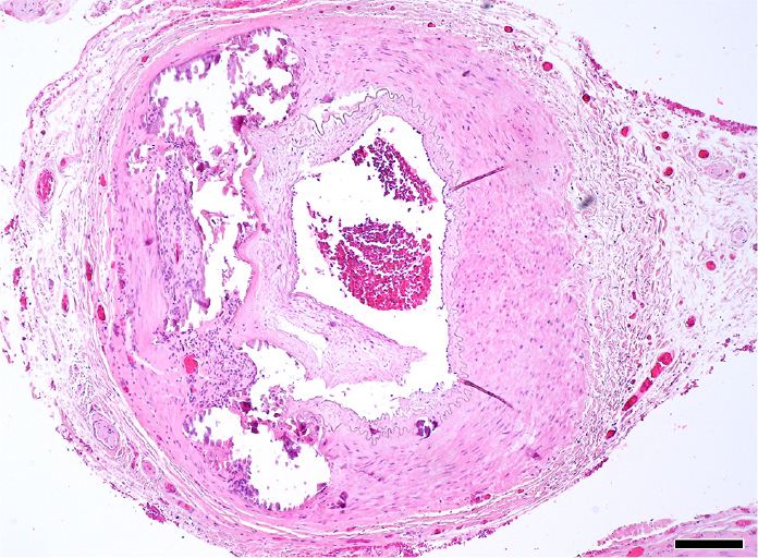 Mönckeberg sclerosis with giant cells as a masquerade of giant cell arteritis.