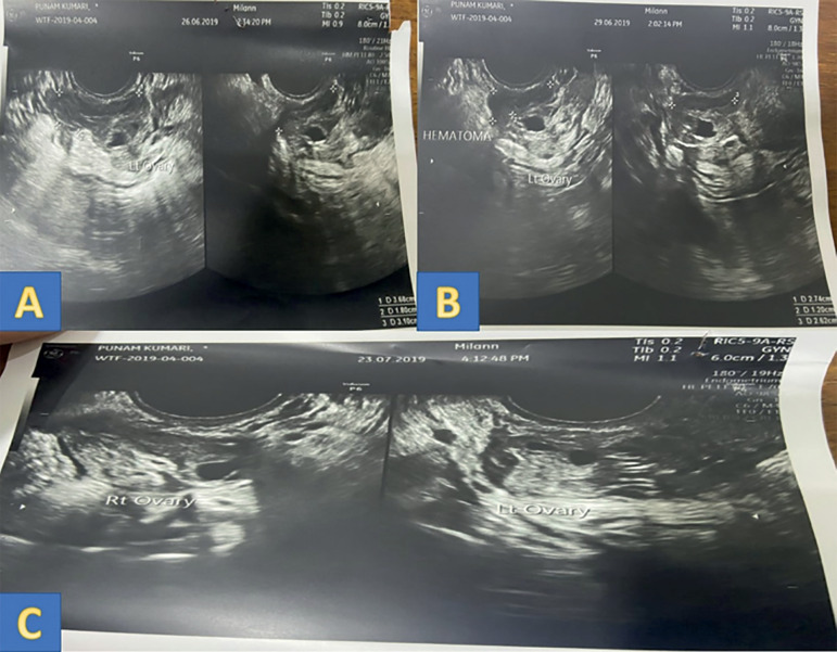 Management of peri-ovarian hematoma following oocyte retrieval in a pooling cycle IVF: Case report.