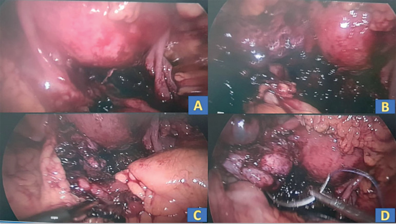 Management of peri-ovarian hematoma following oocyte retrieval in a pooling cycle IVF: Case report.