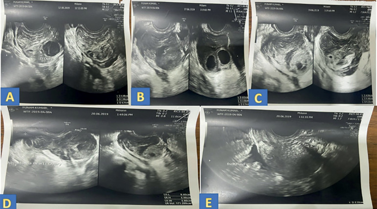 Management of peri-ovarian hematoma following oocyte retrieval in a pooling cycle IVF: Case report.
