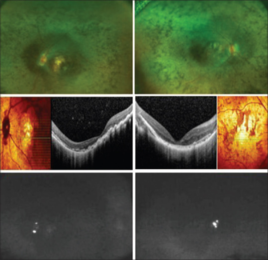 A Novel Missense Variant C.2571 (P.Ala857=) of the DHX38 Gene in a Saudi Family Causes an Autosomal Recessive Retinitis Pigmentosa.