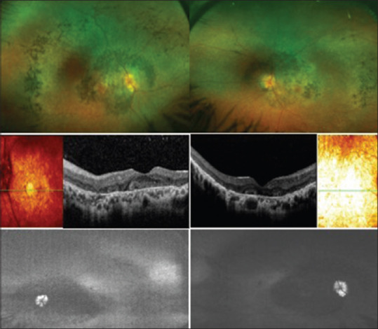 A Novel Missense Variant C.2571 (P.Ala857=) of the DHX38 Gene in a Saudi Family Causes an Autosomal Recessive Retinitis Pigmentosa.