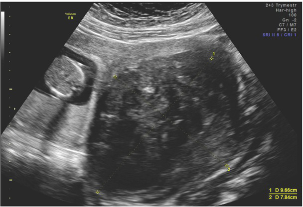 Uterine Myomas and Sarcomas - Clinical and Ultrasound Characteristics and Differential Diagnosis Using Pulsed and Color Doppler Techniques.