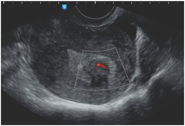 Uterine Myomas and Sarcomas - Clinical and Ultrasound Characteristics and Differential Diagnosis Using Pulsed and Color Doppler Techniques.