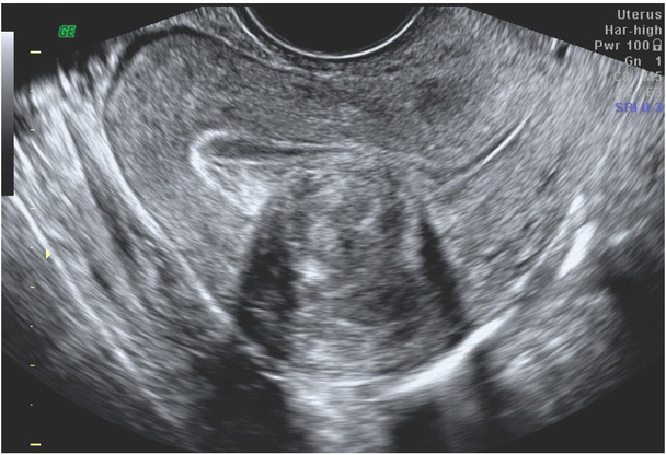 Uterine Myomas and Sarcomas - Clinical and Ultrasound Characteristics and Differential Diagnosis Using Pulsed and Color Doppler Techniques.