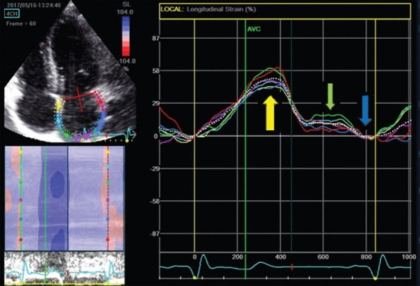 Incremental Value of Left Atrial Function Analysis in the Assessment of Left Ventricular Filling Pressures in Patients with ST-Elevation Myocardial Infarction.