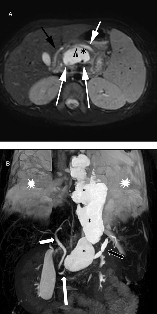 Pancreaticopleural fistula in a Thai boy with <i>SPINK1</i> c.101A>G substitution variant-related chronic pancreatitis: a case report and literature review.