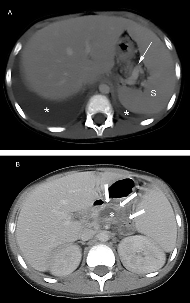 Pancreaticopleural fistula in a Thai boy with <i>SPINK1</i> c.101A>G substitution variant-related chronic pancreatitis: a case report and literature review.