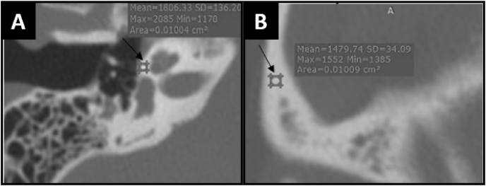 Measuring the density of the fissula antefenestram and the section of the basal turn of the cochlea: Are they useful in the radiological diagnosis of otosclerosis?