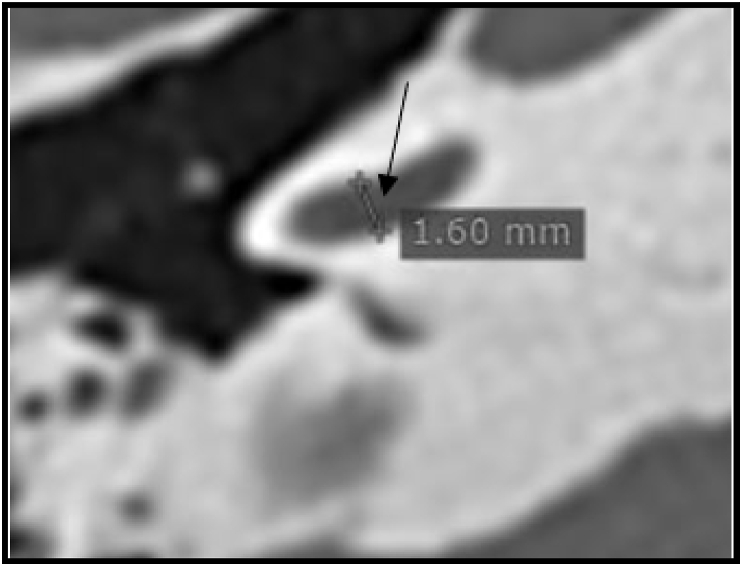 Measuring the density of the fissula antefenestram and the section of the basal turn of the cochlea: Are they useful in the radiological diagnosis of otosclerosis?