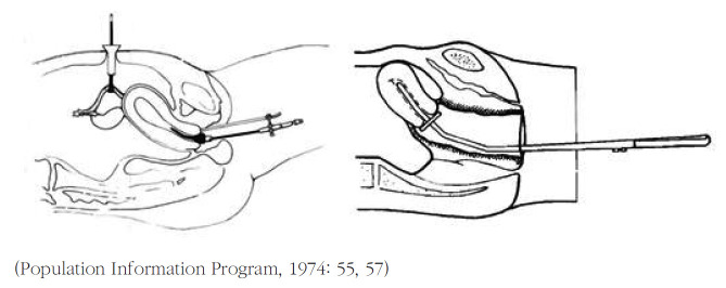 The Desire for Advanced Technology and the Reversal of Appropriateness: the Technological Competition between Laparoscopic Sterilization and Mini-laparotomy in 1960-80s South Korea.