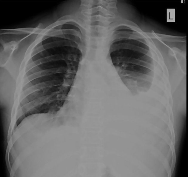 Pancreaticopleural fistula in a Thai boy with <i>SPINK1</i> c.101A>G substitution variant-related chronic pancreatitis: a case report and literature review.