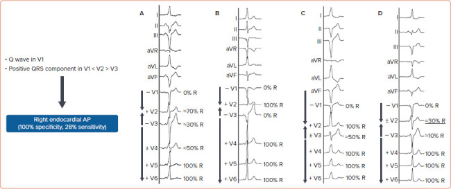 Preprocedural Discrimination of Posteroseptal Accessory Pathways Ablated from the Right Endocardium from Those Requiring a Left-sided or Epicardial Coronary Venous Approach.