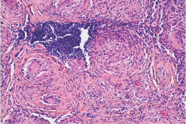 Sarcoidosis of The Breasts - When Should It Be Considered? a Case Report.