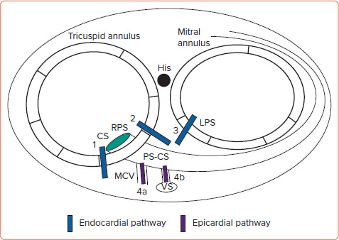 Preprocedural Discrimination of Posteroseptal Accessory Pathways Ablated from the Right Endocardium from Those Requiring a Left-sided or Epicardial Coronary Venous Approach.