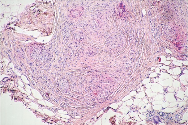 Sarcoidosis of The Breasts - When Should It Be Considered? a Case Report.