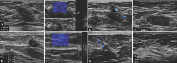 Sarcoidosis of The Breasts - When Should It Be Considered? a Case Report.