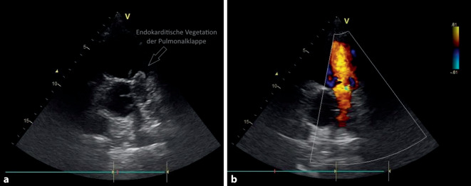 [Pneumonia, endocarditis of two valves and pulmonary artery embolism in a 26-year-old male patient].