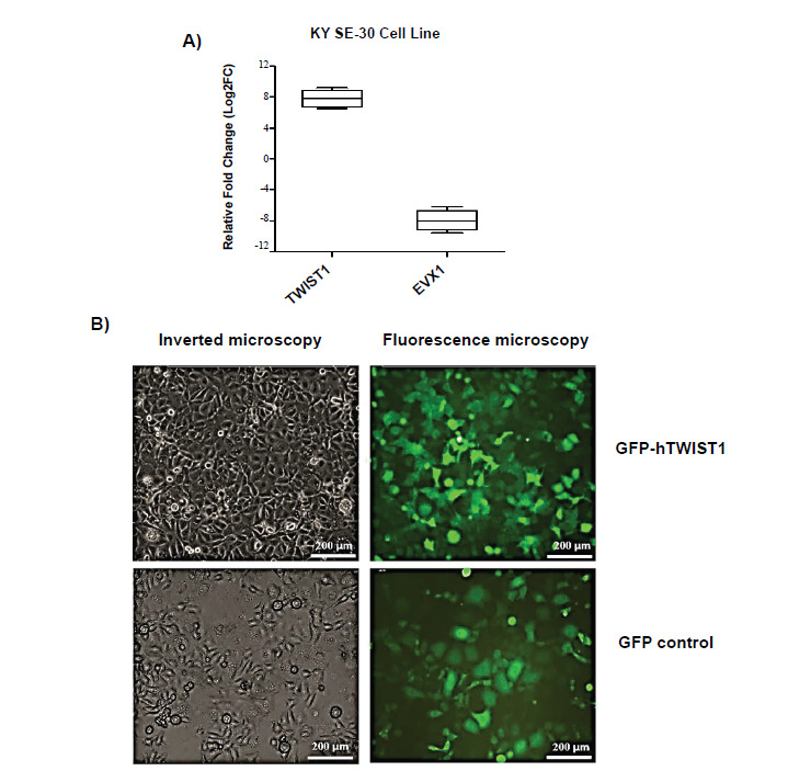 Contribution of TWIST1-EVX1 Axis in Invasiveness of Esophageal Squamous Cell Carcinoma; a Functional Study.