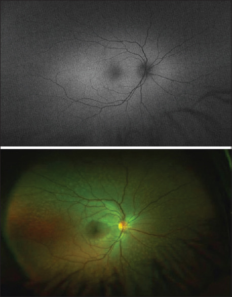 Electrophysiological Evaluation of Fleck Retina and Temporal Macular Thinning in X-Linked Alport's Syndrome.