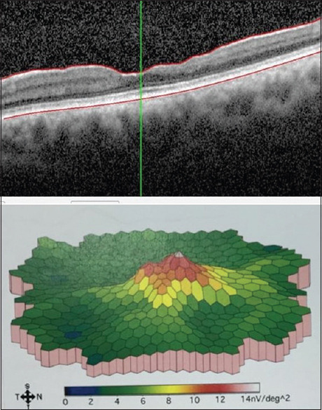 Electrophysiological Evaluation of Fleck Retina and Temporal Macular Thinning in X-Linked Alport's Syndrome.