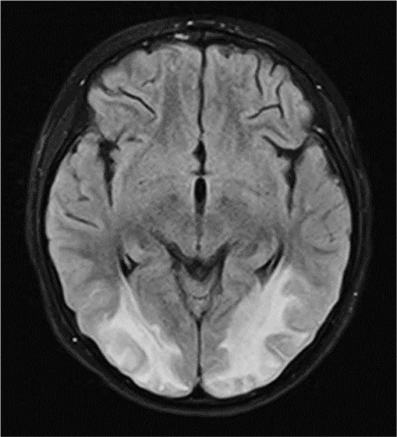 Posterior reversible encephalopathy syndrome in a child with severe multisystem inflammatory syndrome due to COVID-19.