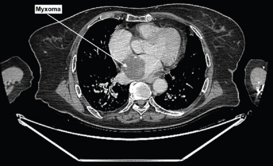 Asymptomatic Left Atrial Myxoma.