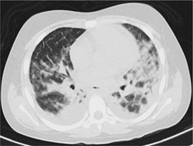 Posterior reversible encephalopathy syndrome in a child with severe multisystem inflammatory syndrome due to COVID-19.