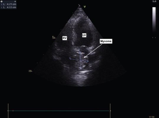 Asymptomatic Left Atrial Myxoma.