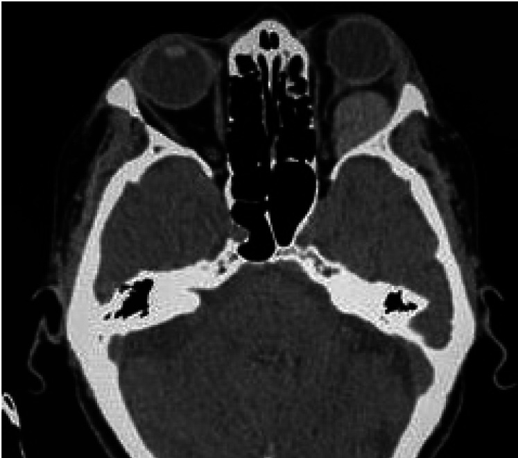 [Spontaneous retrobulbar haemorrhage associated with anticoagulants].