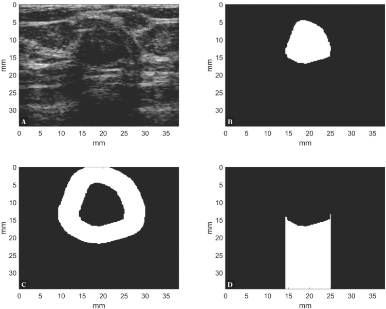 Explaining a Deep Learning Based Breast Ultrasound Image Classifier with Saliency Maps.