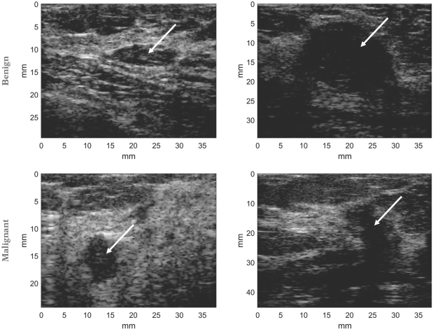 Explaining a Deep Learning Based Breast Ultrasound Image Classifier with Saliency Maps.