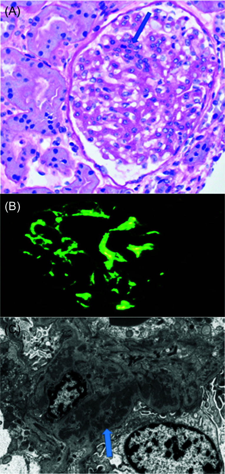 Adalimumab-Induced Lupus Nephritis: Case Report and Review of the Literature.