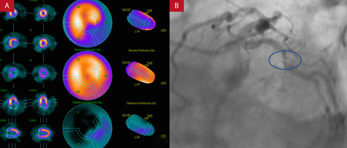 [Prediction of significant coronary lesions by SPECT myocardial perfusion. Results from a national reference hospital in Lima-Peru].