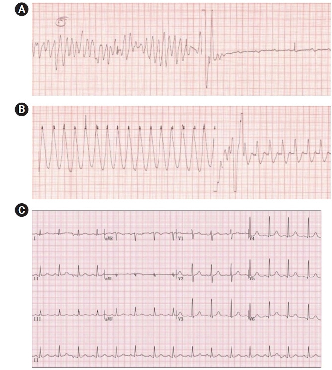 Two cases of late-onset cardiovascular toxicities after a single injection of local anesthetics during supraclavicular brachial plexus block - A report of two cases.