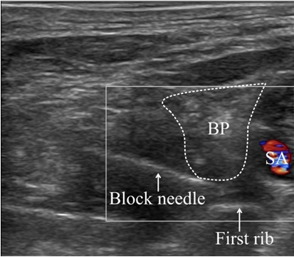 Two cases of late-onset cardiovascular toxicities after a single injection of local anesthetics during supraclavicular brachial plexus block - A report of two cases.