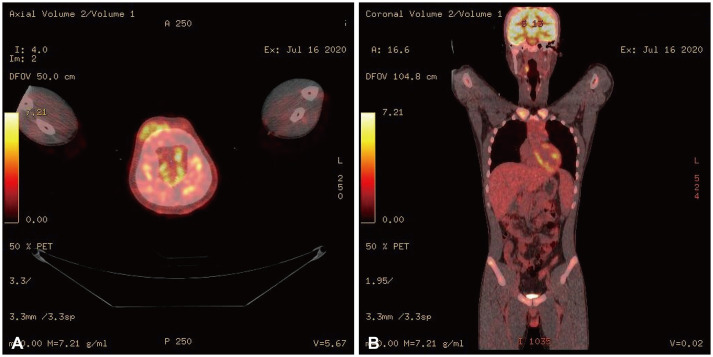 Peripheral T-Cell Lymphoma Presenting as a Scalp Mass.