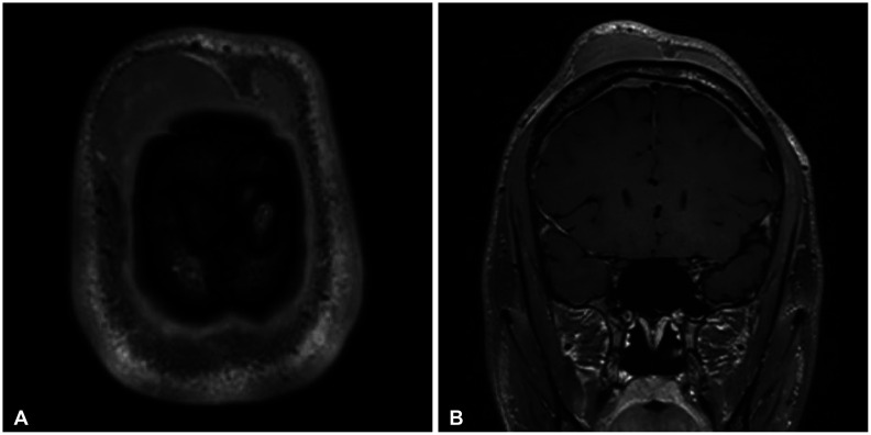 Peripheral T-Cell Lymphoma Presenting as a Scalp Mass.