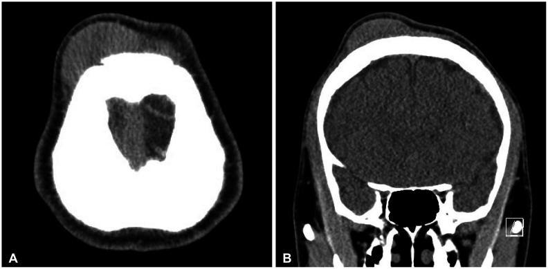 Peripheral T-Cell Lymphoma Presenting as a Scalp Mass.