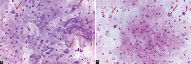 Exfoliation of Uterine Leiomyosarcoma in Cervical Scrape Smear with Histopathological Correlation.