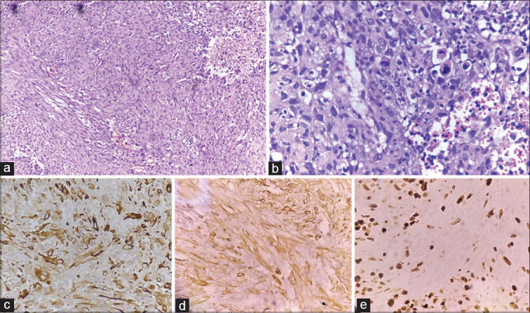 Exfoliation of Uterine Leiomyosarcoma in Cervical Scrape Smear with Histopathological Correlation.