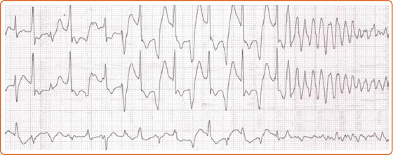 Catecholaminergic Polymorphic Ventricular Tachycardia.