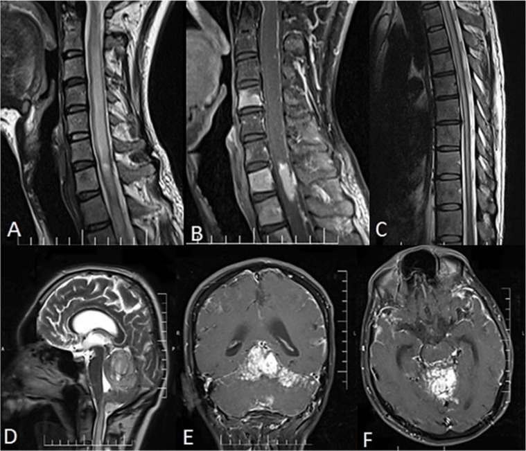 Diffuse leptomeningeal glioneuronal tumor (DLGNT) with hydrocephalus as an initial symptom mimicking tuberculous meningitis: A case report.